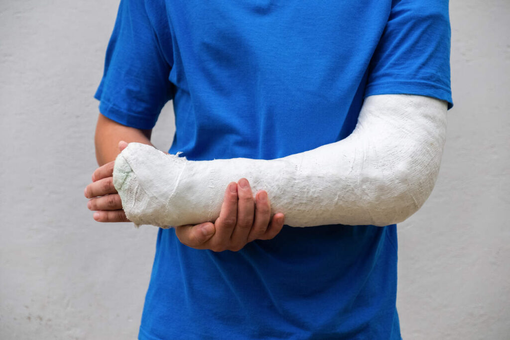 Person with a severely casted arm, symbolizing a permanent workplace injury in North Carolina and the need for available benefits.